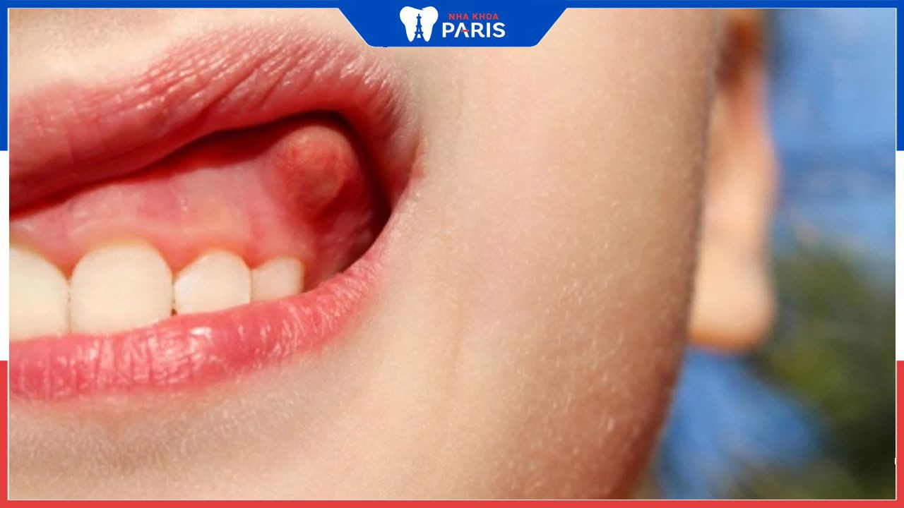 Áp xe răng có tự khỏi không | Phương pháp điều trị hiệu quả